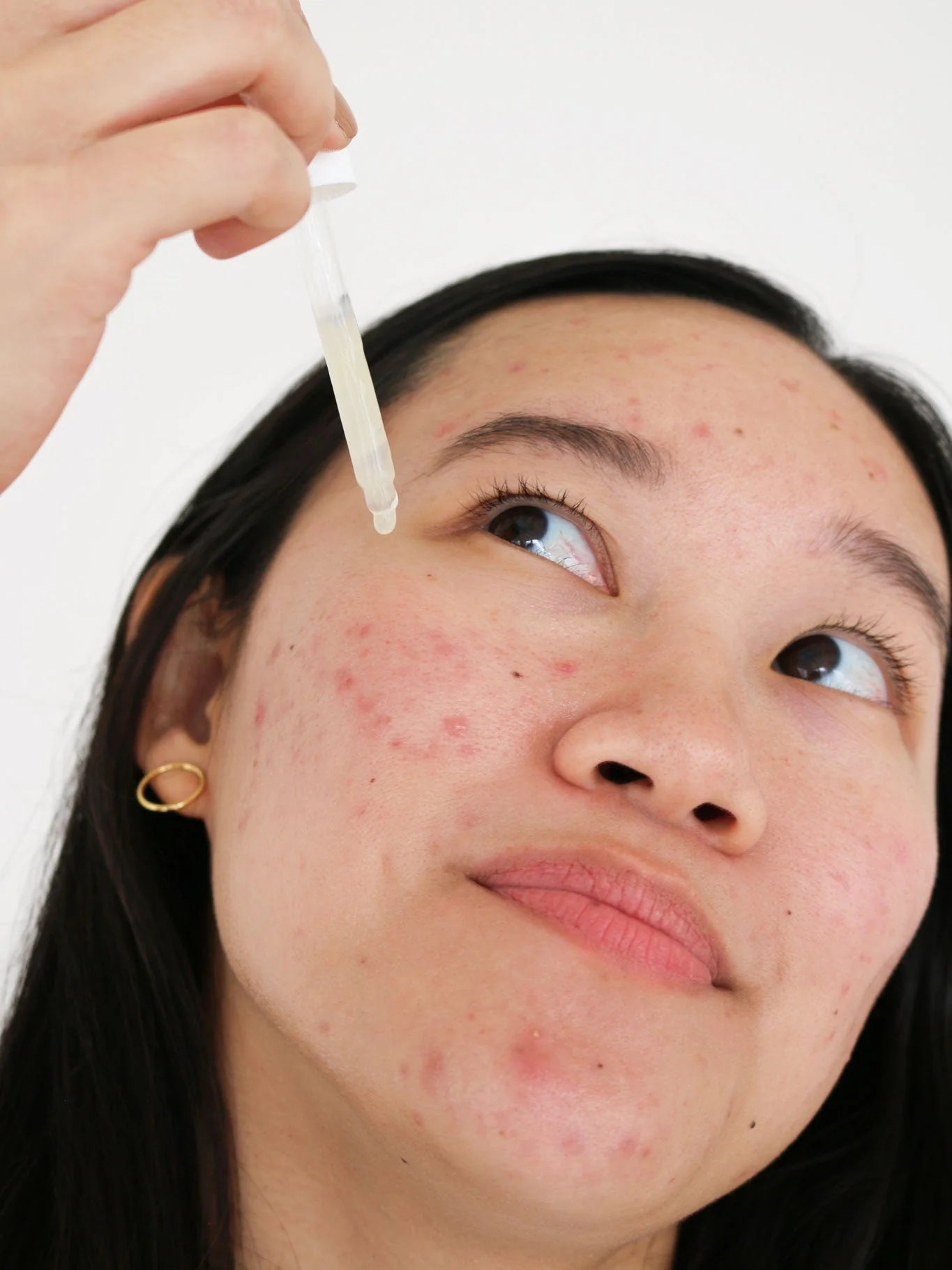 Postbiotic Acne Serum - Living with Ivey